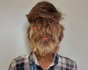 Indian Man Sets Guinness World Record for Hairiest Face.